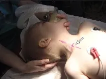 Катетеризація центральних вен під ультразвуковим контролем. центральних