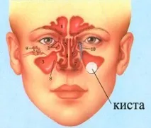 киста максиларния