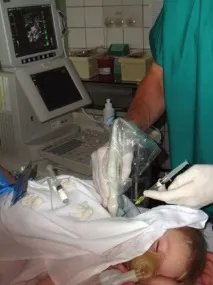 Катетеризація центральних вен під ультразвуковим контролем. центральних