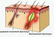 Лікування гідраденіту – запалення потових залоз лікування