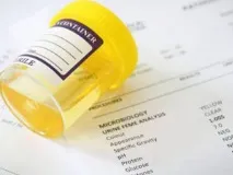 Лейкоцити в сечі при вагітності чому вони з’являються і що робити при підвищеному рівні лейкоцити