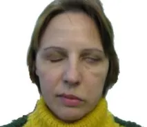 нерв лицевия