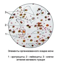 Лейкоцити у сечі при вагітності підвищені причини, лікування причини