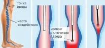 Лікування варикозу без операції відгуки, медикаменти, народні засоби відгуки