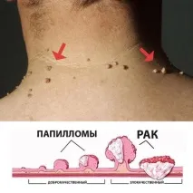доброкачествен развие