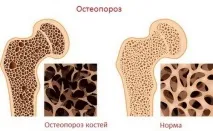 костната плътност
