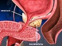 Рак простати - Лікування в Німеччині простати