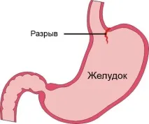 Блювота з кров’ю причини, діагностика, лікування блювота