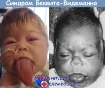Синдром Беквіта-Відемана може