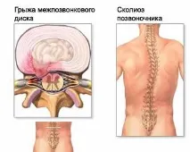 Спондилодез поперекового відділу хребта спондилодез