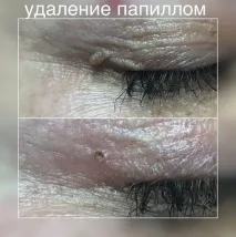 видалення