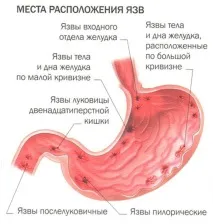 Трави та чаї при виразці шлунка та дванадцятипалої кишки що пити для лікування виразці