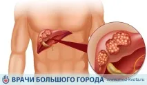 Хіміотерапія при раку печінки вартість, наслідки, ціна, види печінки