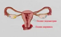 възможно полип