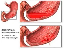 пептична пептична