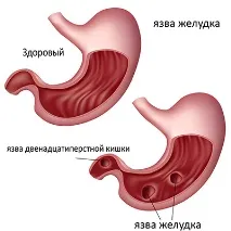 пептична язва