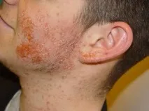 Staphylococcus aureus стафилококус ауреус