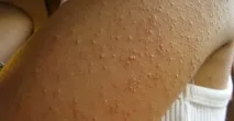 алергия диета