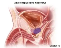 передміхурової