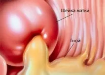 атрофичен цервицит цервицит