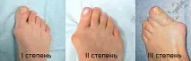 засегнатата става краката