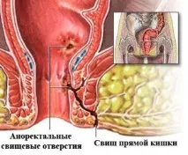 фистула ректума