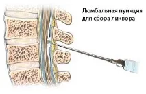 Енцефалопатія головного мозку енцефалопатія
