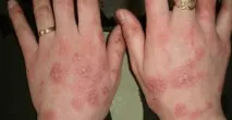 плаки елементи