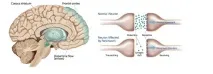 ХВОРОБА ПАРКІНСОНА - Parkinson s Disease (PD) - Case Studies - Ukrainian Puhua International Hospital parkinson