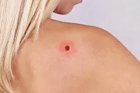 какво лазмед