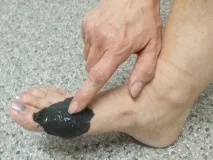 подагру