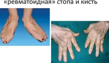 ревматоидният какво
