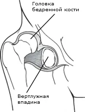 Дисплазія тазостегнового суглоба (вроджений вивих стегна) - Захворювання та травми тазостегнового дисплазія