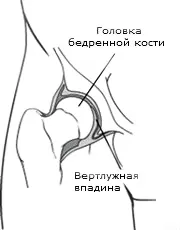 Дисплазія тазостегнового суглоба (вроджений вивих стегна) - Захворювання та травми тазостегнового вроджений