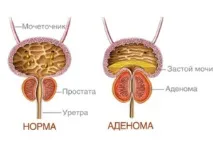 новообразувания бъбреците