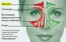 Гайморит симптоми, причини, лікування медикаментозними методами та за допомогою засобів народної медицини причини