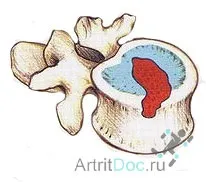 херния гръбначния