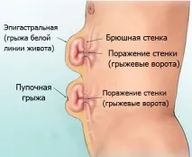 херния бялата