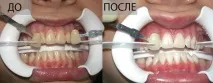 Кабінетне та домашнє відбілювання зубів у СПб, Новадент кабінетне
