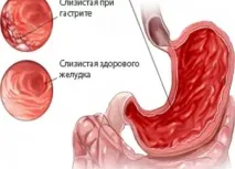 Як лікувати хронічний гастрит. гастриту