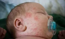 алергия алергични