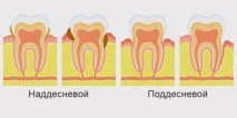 Як виглядає зубний камінь у людини піддесновою та наддесновою людини
