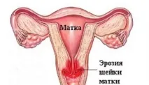 ерозията шийка