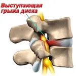 Лікування остеохондрозу вдома остеохондрозу