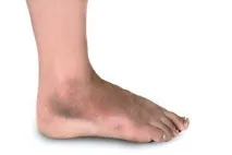 фрактура лечение