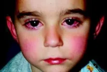 лечение менингит