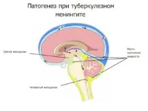 туберкулозен менингит