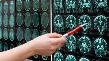 демиелинизиращи процеси демиелинизиращи процеси