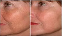 лице мезоботокс