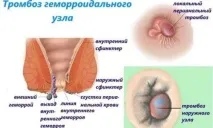 Траумель при геморої властивості, застосування таблеток, крапель та мазі. властивості